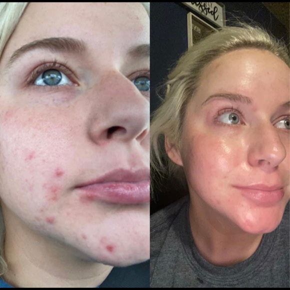 Normal/Combo Lumispa Essential Kit - Picture 3 of 3